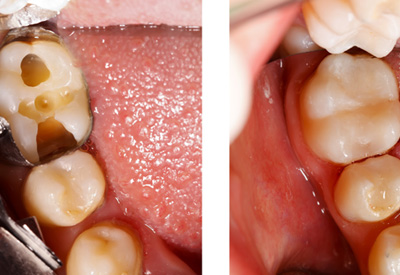  Fillings and Restorations