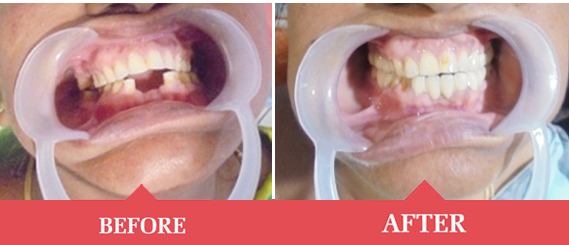 placement of dental implant